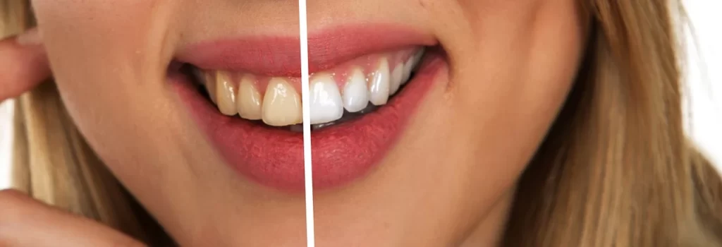 ¿Un irrigador bucal puede servir para eliminar manchas en los dientes?